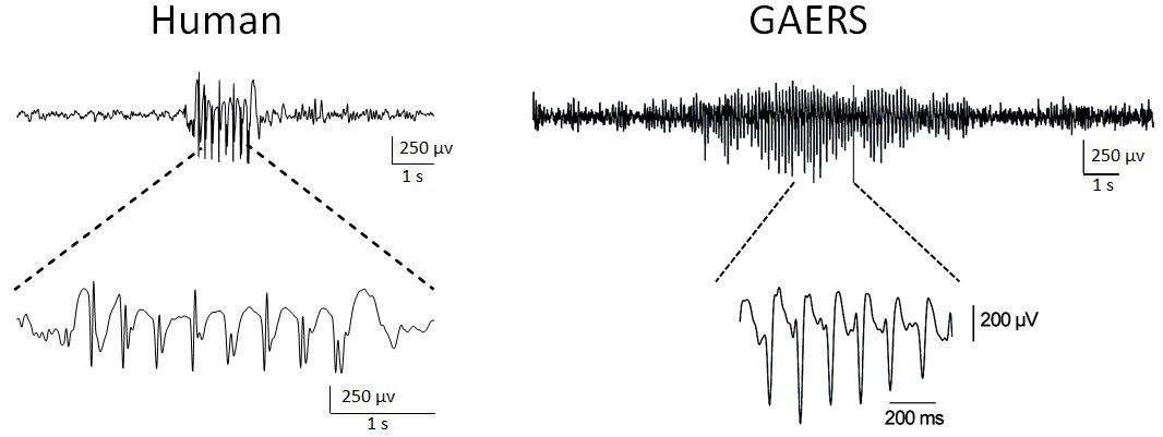 Enregistrement EEG d'une crise d'absence chez l'homme (à gauche) et chez le rat GAERS (à droite)