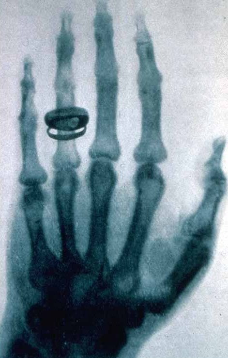 Une des premières radiographies, prise par Wilhelm Röntgen