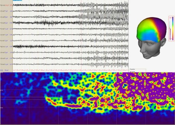 Électro-encéphalographie lors d'une crise temporale gauche